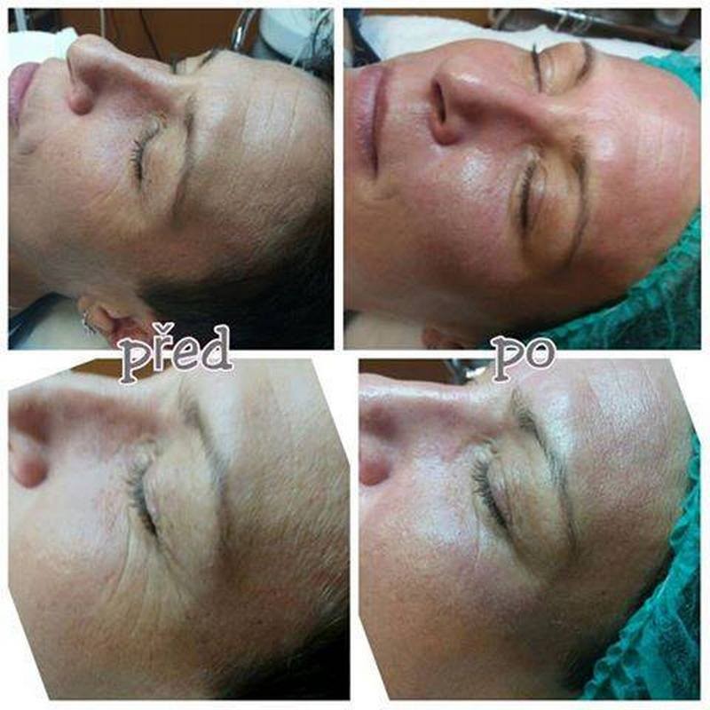 Dárkový poukaz Microneedling - jehličková mezoterapie – náhled 3
