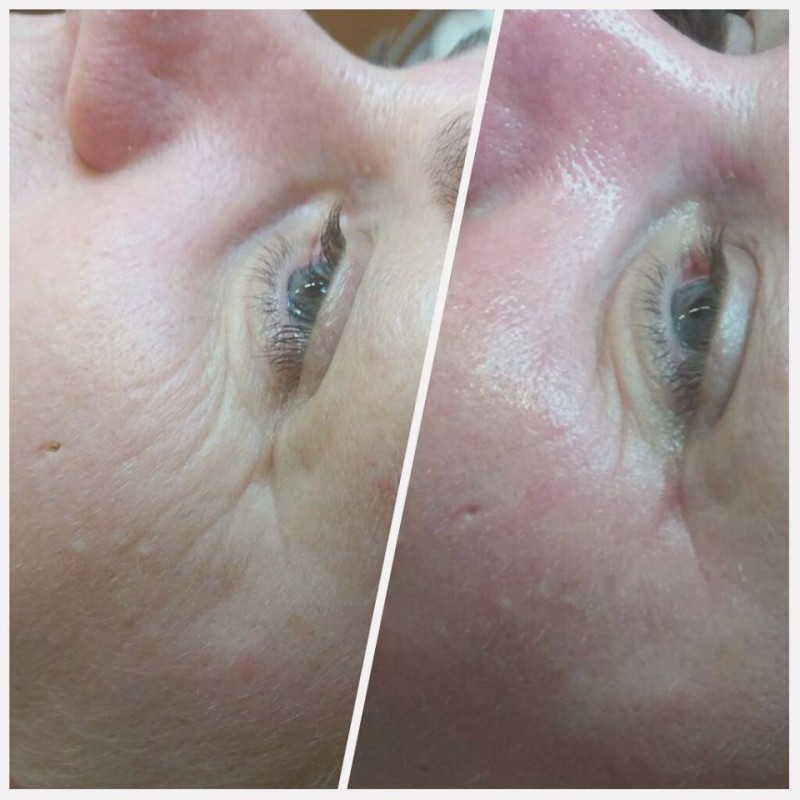 Dárkový poukaz Microneedling - jehličková mezoterapie – náhled 2